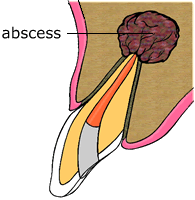 abscess